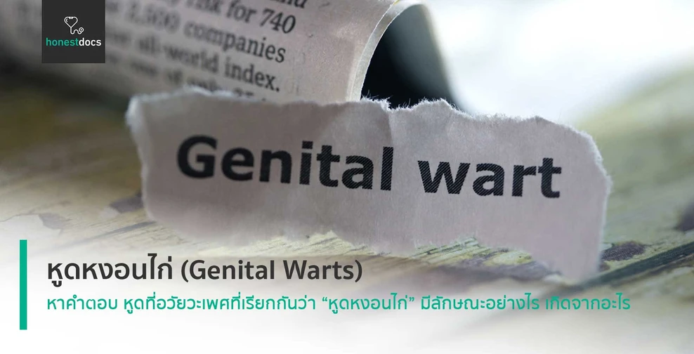 หูดหงอนไก่ (Genital Warts)