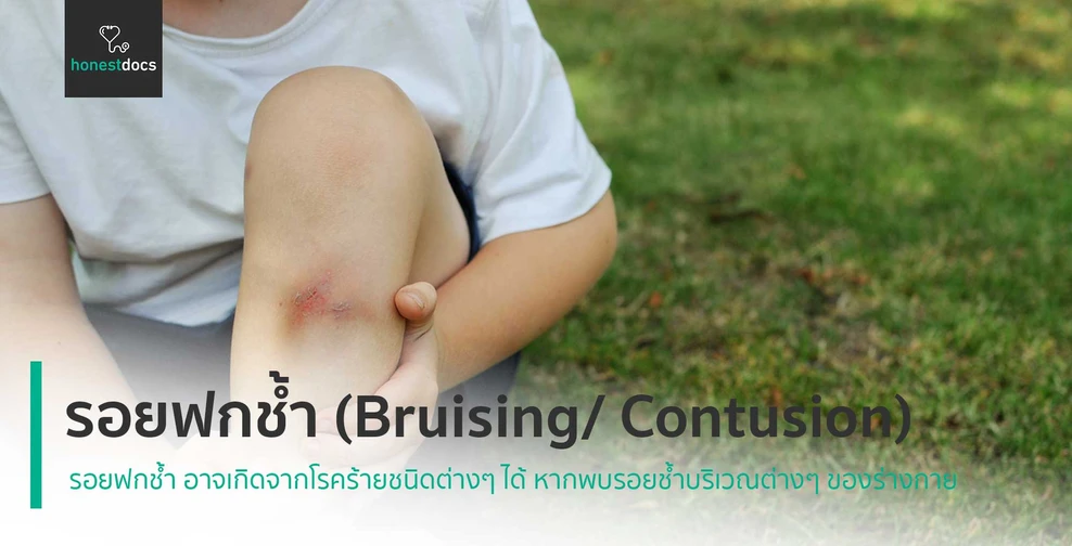 รอยฟกช้ำ (Bruising/ Contusion)