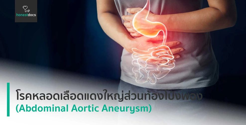 โรคหลอดเลือดแดงใหญ่ส่วนท้องโป่งพอง (Abdominal Aortic Aneurysm)