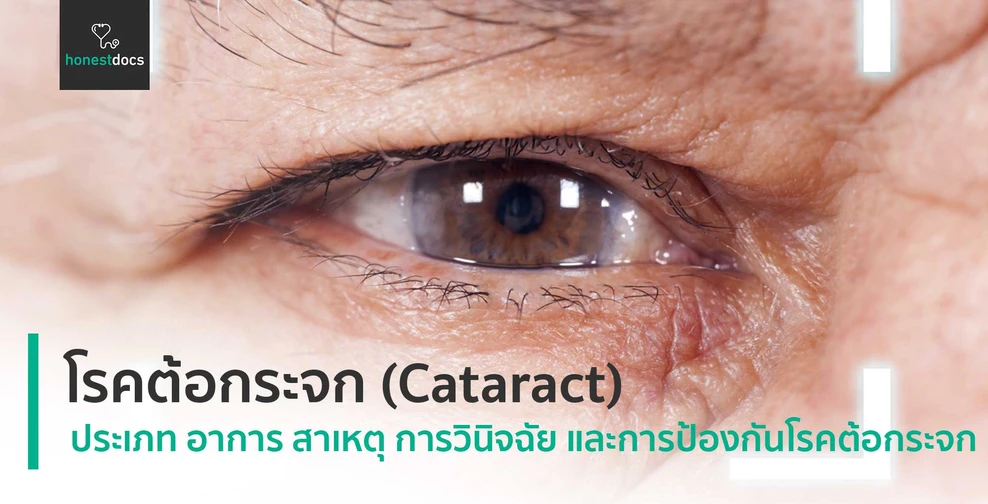 โรคต้อกระจก (Cataract)