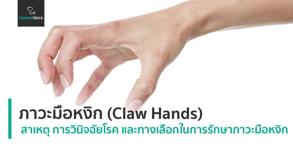 ภาวะมือหงิก (Claw Hands)
