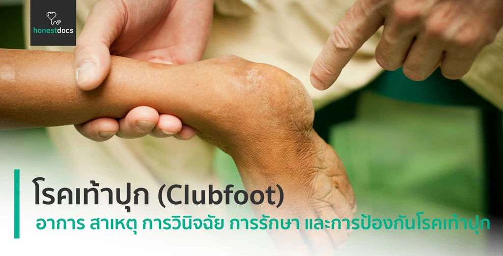 โรคเท้าปุก (Clubfoot)