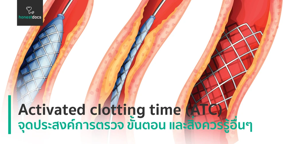 Activated clotting time (ACT)