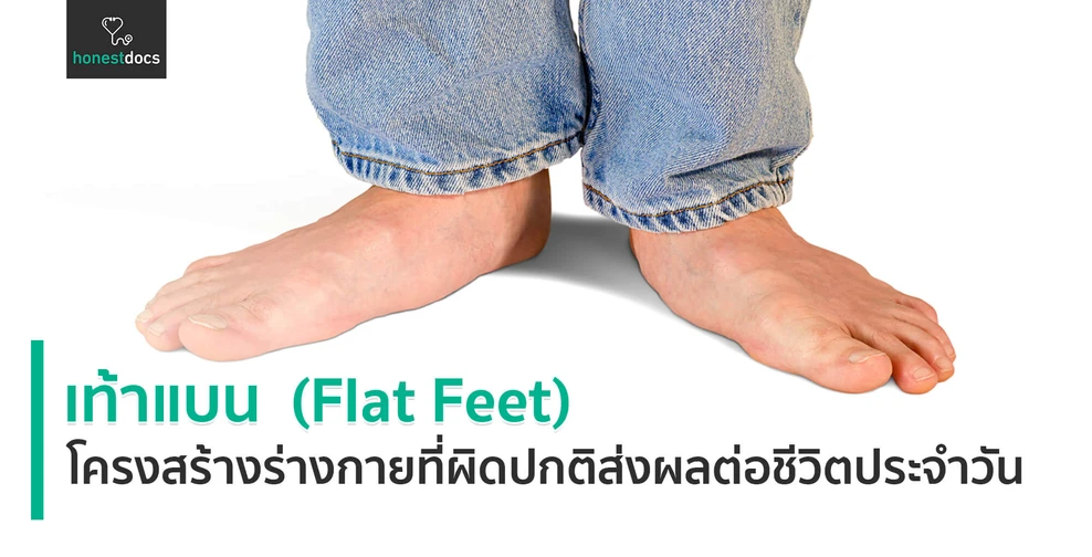 เท้าแบน (Flat Feet)