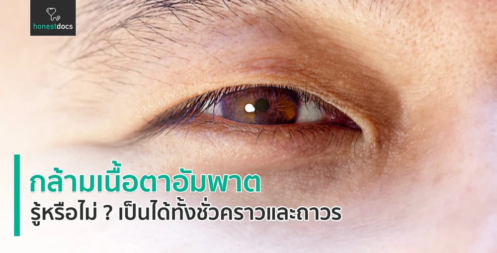 กล้ามเนื้อตาอัมพาต (Ophthalmoplegia)