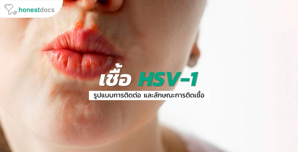 เชื้อ HSV-1 คืออะไร?