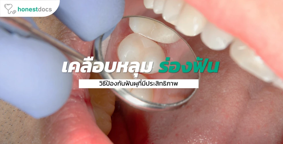 เคลือบหลุมร่องฟัน วิธีป้องกันฟันผุที่มีประสิทธิภาพ