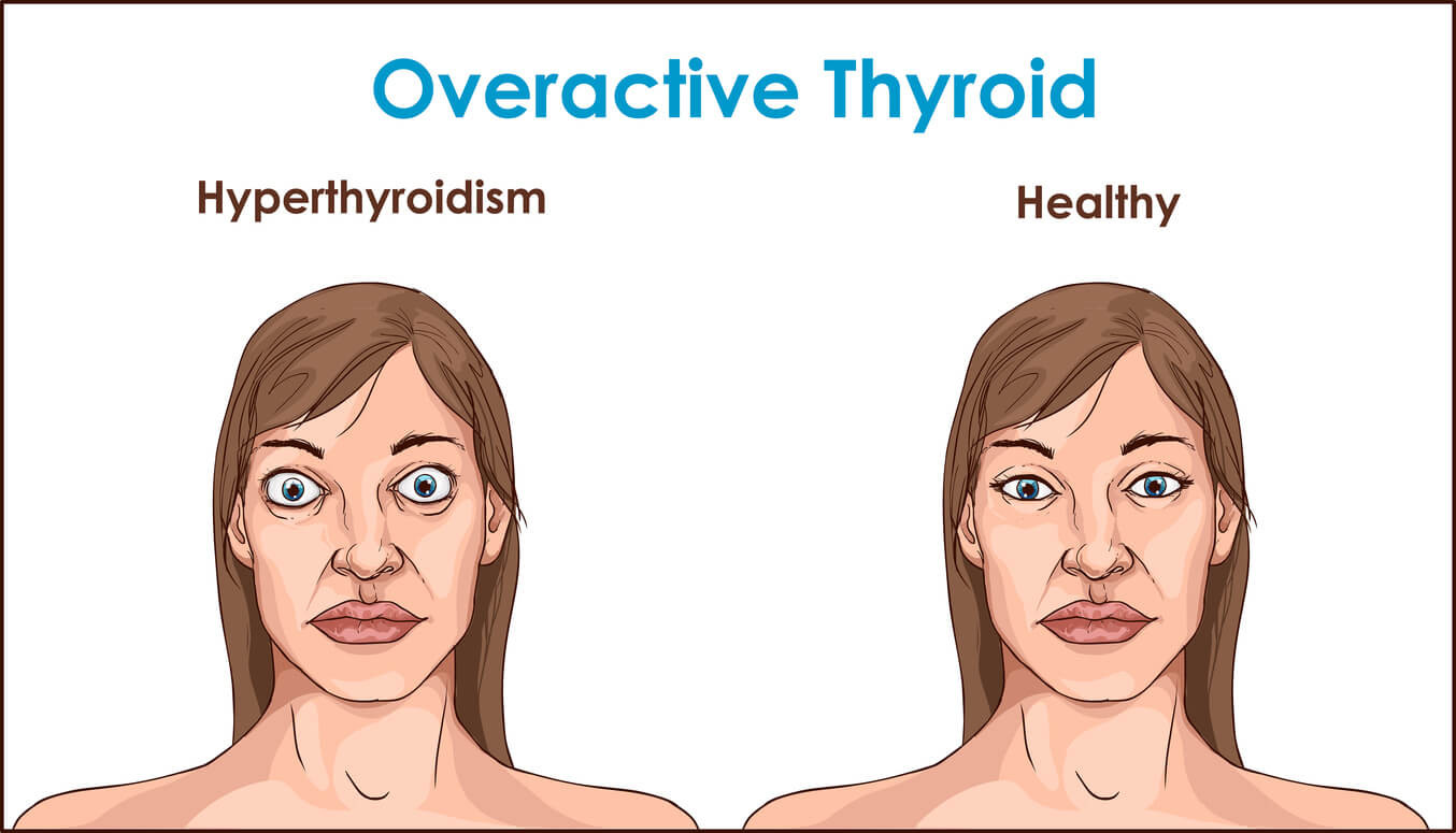 Does Hyperthyroidism Cause Face Swelling