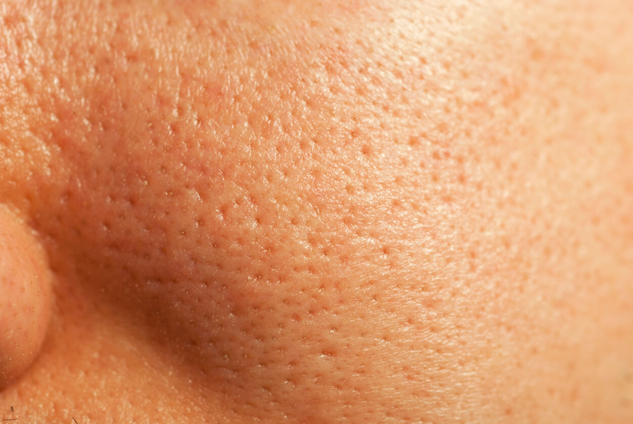 What can treat large facial pores?