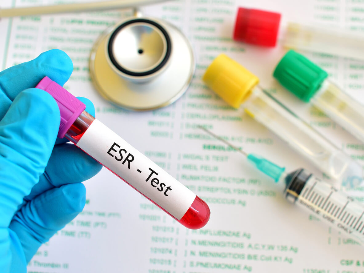 การตรวจ ESR | HD สุขภาพดี เริ่มต้นที่นี่
