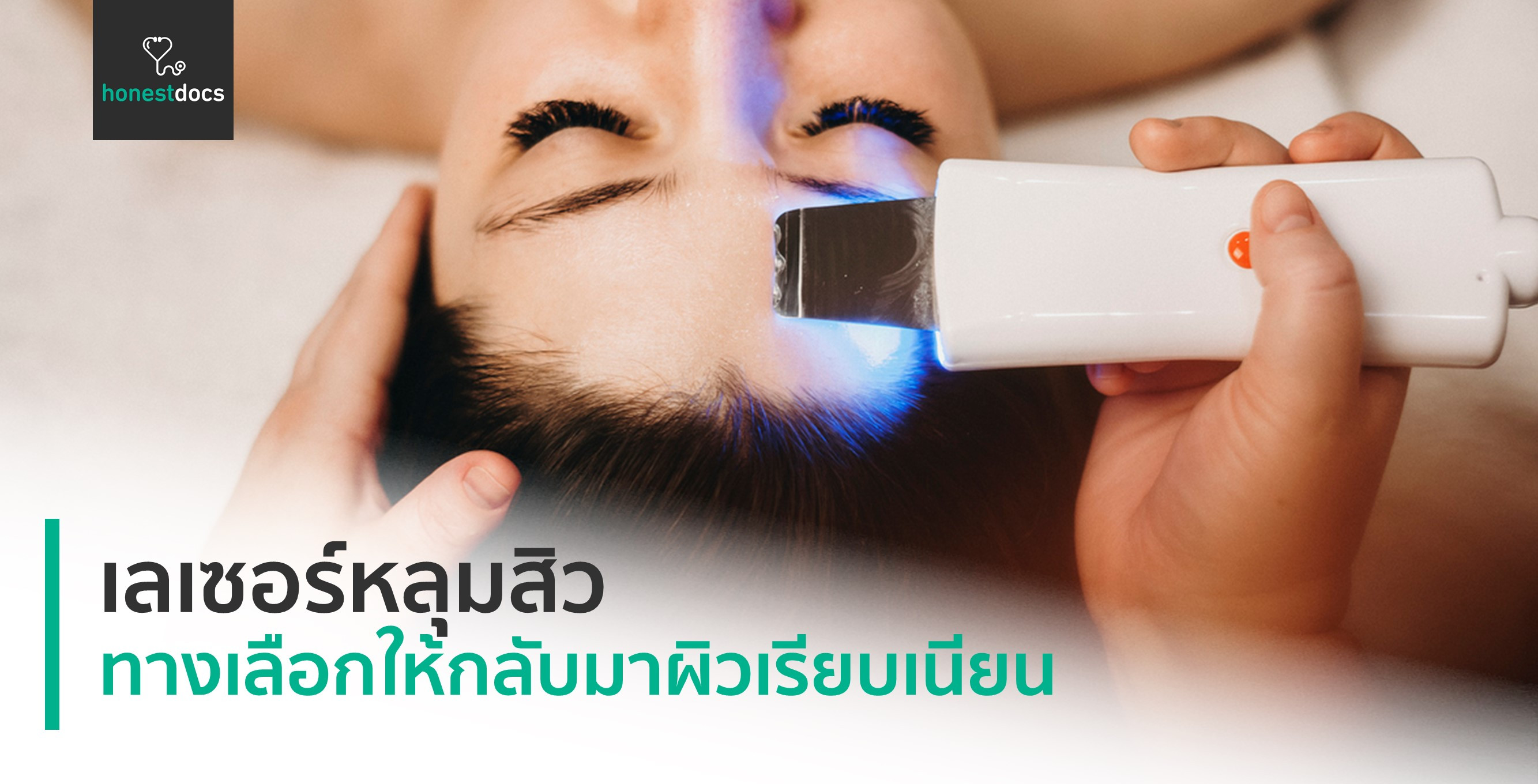 เลเซอร์หลุมสิว ที่ไหนดี? รวมคลินิกชื่อดังในกรงเทพฯ | Hd สุขภาพดี ...