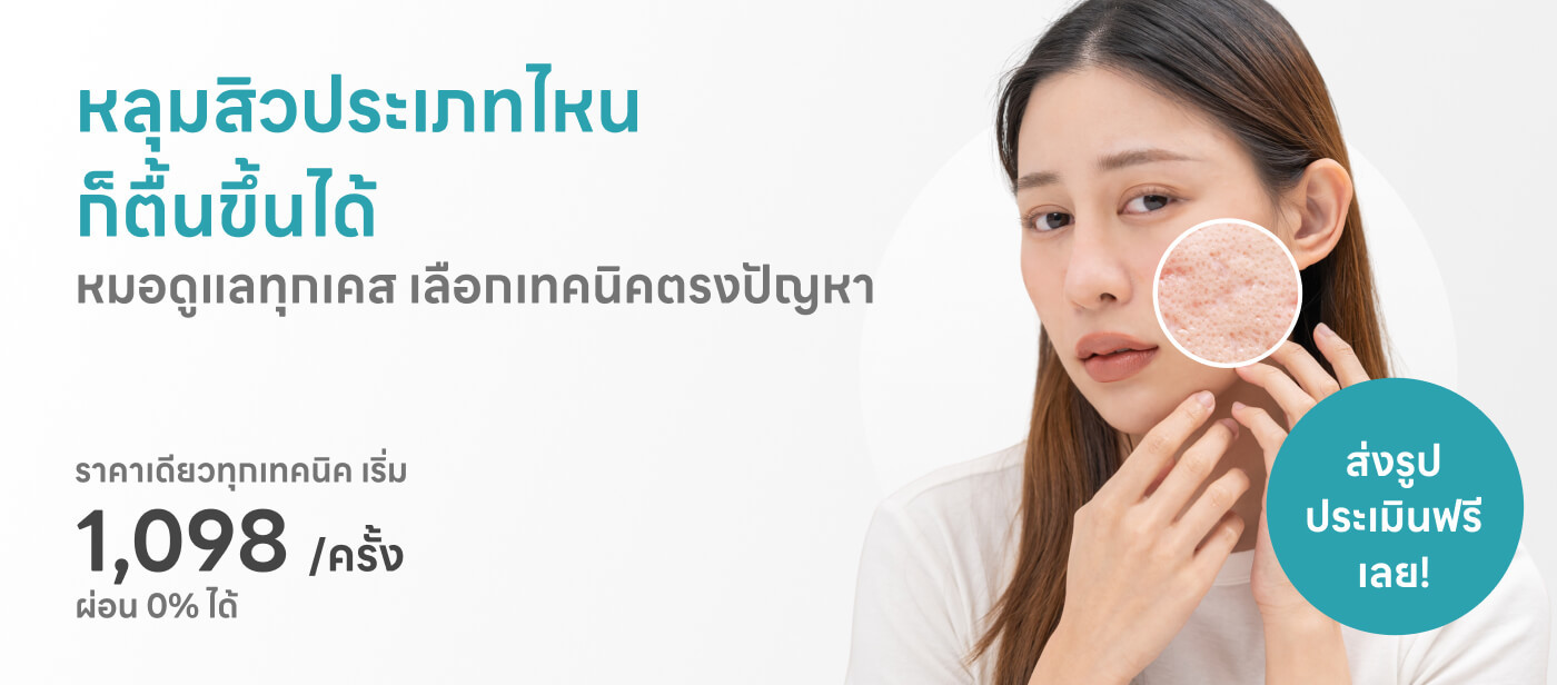 รักษาหหลุมสิว