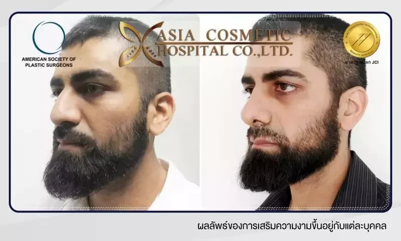 ภาพ Before After เสริมจมูกผู้ชาย ที่ โรงพยาบาลเอเซีย