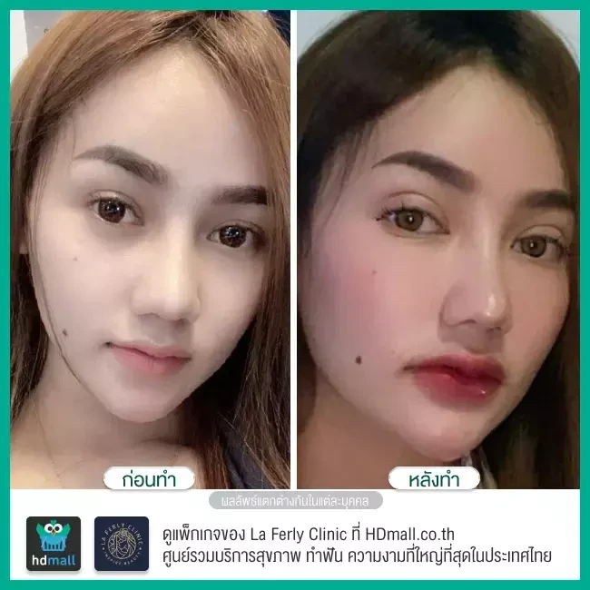 Before After ทำตาสองชั้น ที่ La Ferly Clinic