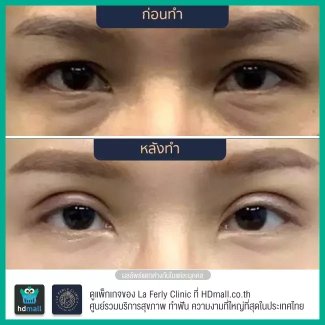 Before After ทำตาสองชั้น ที่ La Ferly Clinic