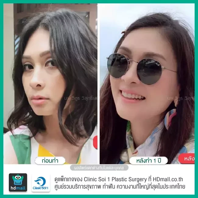 Before After ทำคาง ที่ Clinic Soi 1 Plastic Surgery