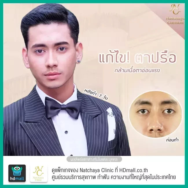 Before After รีวิวศัลยกรรมตา แก้ไขตาอ่อนแรง ที่ Natchaya Clinic