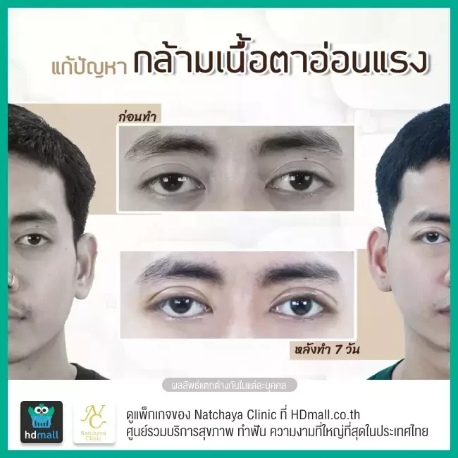 Before After รีวิวศัลยกรรมตา แก้ไขตาอ่อนแรง ที่ Natchaya Clinic