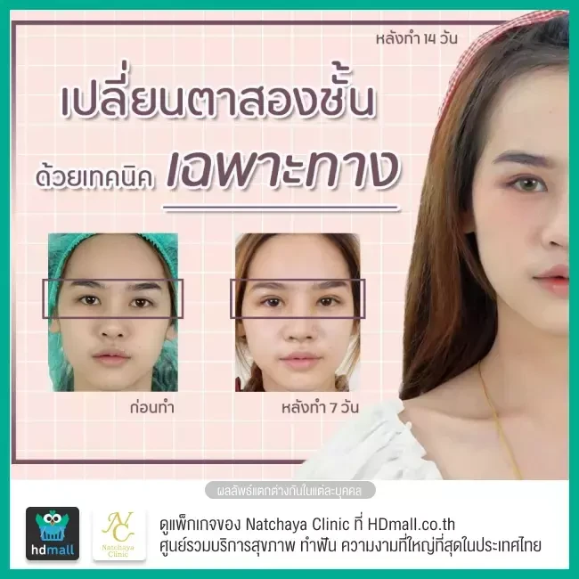 Before After รีวิวศัลยกรรมตา แก้ไขตาอ่อนแรง ที่ Natchaya Clinic