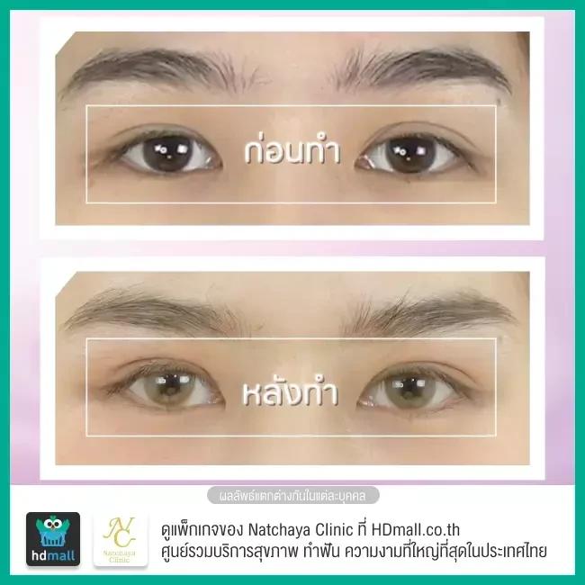 Before After รีวิวศัลยกรรมตา แก้ไขตาอ่อนแรง ที่ Natchaya Clinic