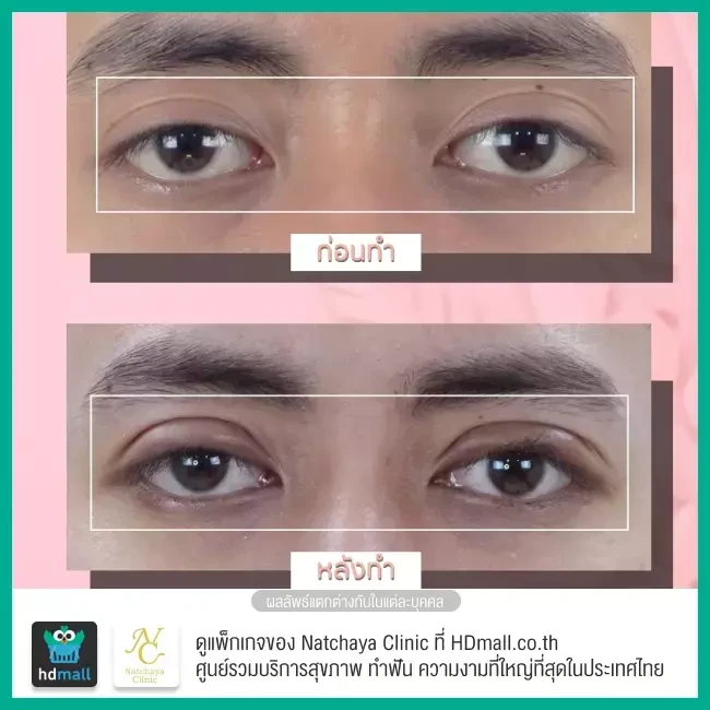 Before After รีวิวศัลยกรรมตา แก้ไขตาอ่อนแรง ที่ Natchaya Clinic