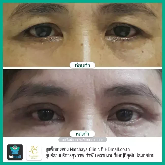 Before After รีวิวศัลยกรรมตา แก้ไขตาอ่อนแรง ที่ Natchaya Clinic