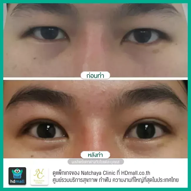 Before After รีวิวศัลยกรรมตา แก้ไขตาอ่อนแรง ที่ Natchaya Clinic