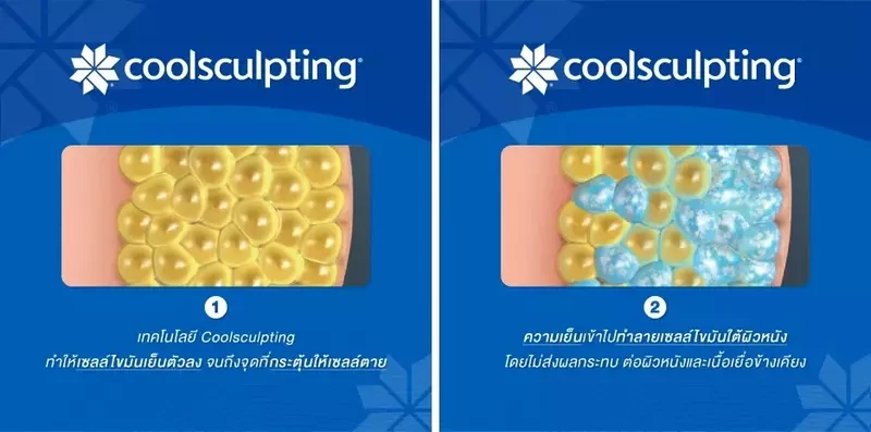 กระบวนการฆ่าเซลล์ไขมันผ่านการใช้เทคโนโลยี CoolSculpting