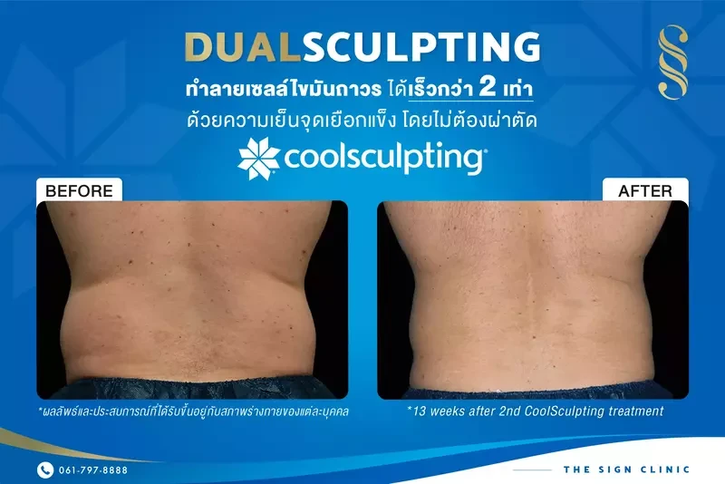 รีวิวผลลัพธ์การสลายไขมันด้วย CoolSculpting ที่ The Sign Clinic (ทองหล่อ)