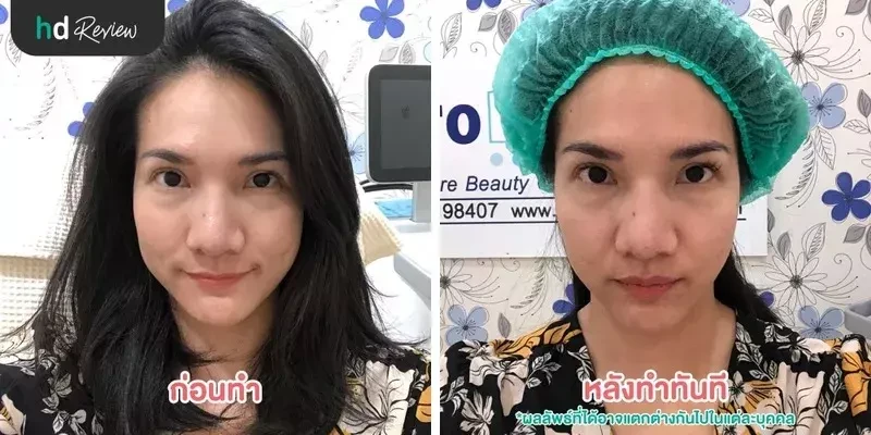 Before After การทำ Thermage FLX ยกกระชับหน้า ที่ ProDerma Aesthetic Clinic