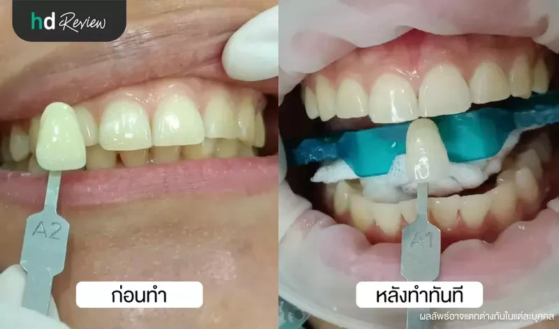 เปรียบเทียบก่อนและหลังฟอกสีฟัน ด้วยระบบ Cool Light ที่ Tooth Box Dental Clinic