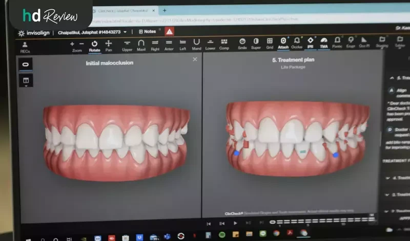 ภาพกราฟิกแผนการจัดฟันใส Invisalign จัดฟันรอบสอง ที่ Dentist at Home Dental Clinic