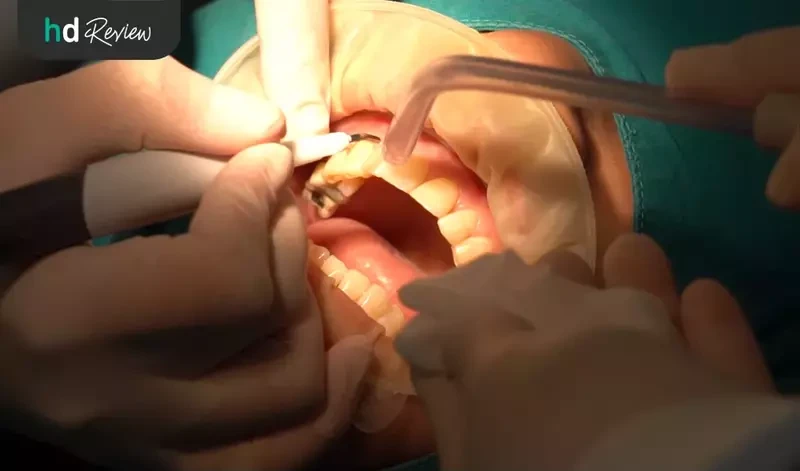 ขั้นตอนการตัดเหงือกด้วยเลเซอร์ ที่ Grace Dental Clinic