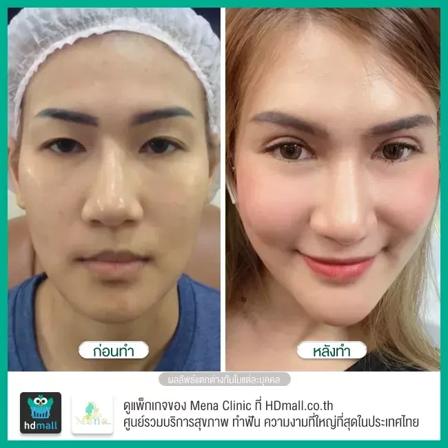 รีวิว ทำตาสองชั้น แก้ไขกล้ามเนื้อตาอ่อนแรง ที่ Mena Clinic