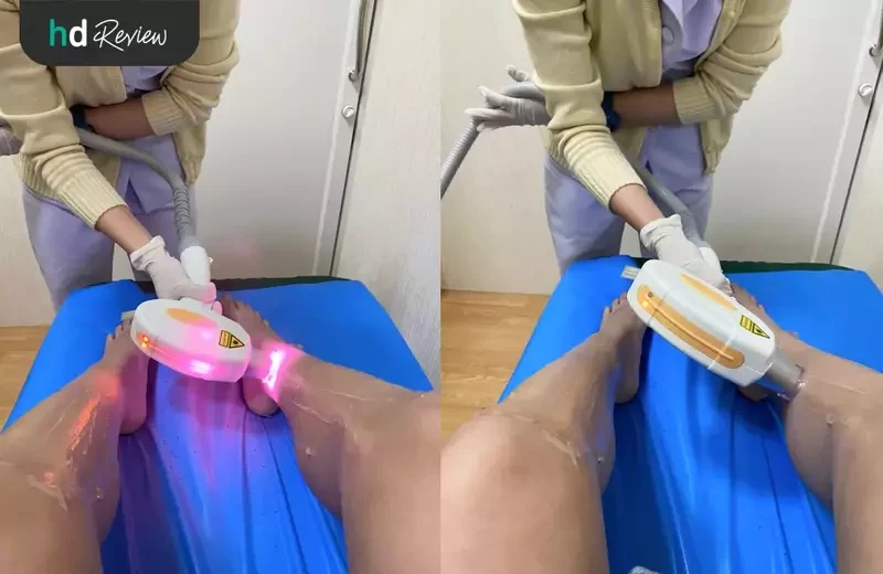 ขั้นตอนการกำจัดขนขาล่าง ด้วย Diode Laser ที่ Cher Clinic