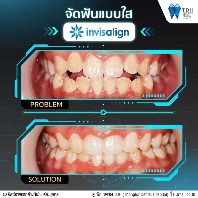 รีวิว จัดฟัน Invisalign ที่ Thonglor Dental Hospital (TDH)