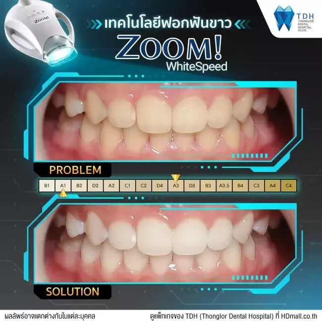 รีวิว ฟอกสีฟันแบบ Zoom ที่ Thonglor Dental Hospital (TDH)