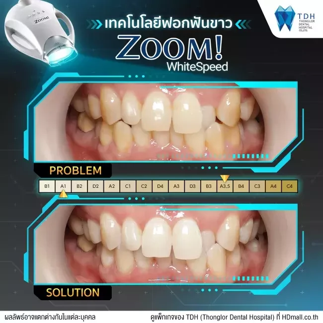 รีวิว ฟอกสีฟันแบบ Zoom ที่ Thonglor Dental Hospital (TDH)
