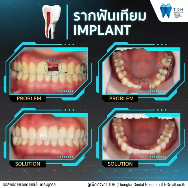 รีวิวทำรากฟันเทียม