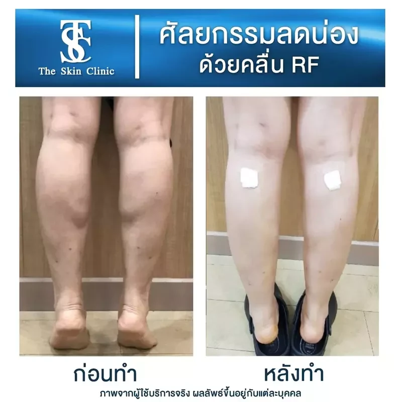 รีวิว ลดน่องด้วยคลื่น RF ที่ The Skin Clinic