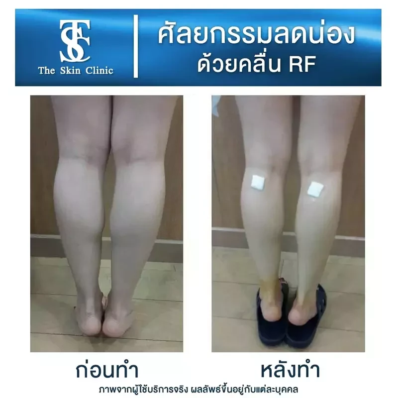 รีวิว ลดน่องด้วยคลื่น RF ที่ The Skin Clinic