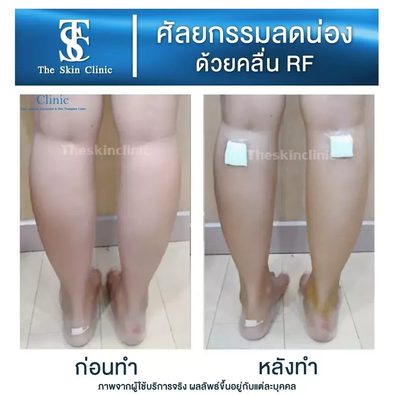 รีวิว ลดน่องด้วยคลื่น RF ที่ The Skin Clinic