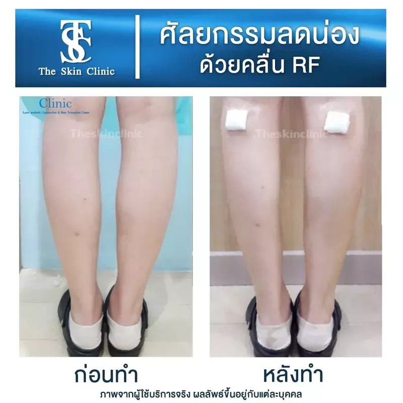 รีวิว ลดน่องด้วยคลื่น RF ที่ The Skin Clinic