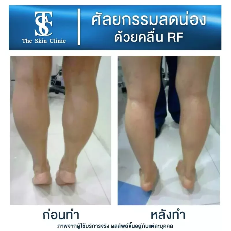 รีวิว ลดน่องด้วยคลื่น RF ที่ The Skin Clinic