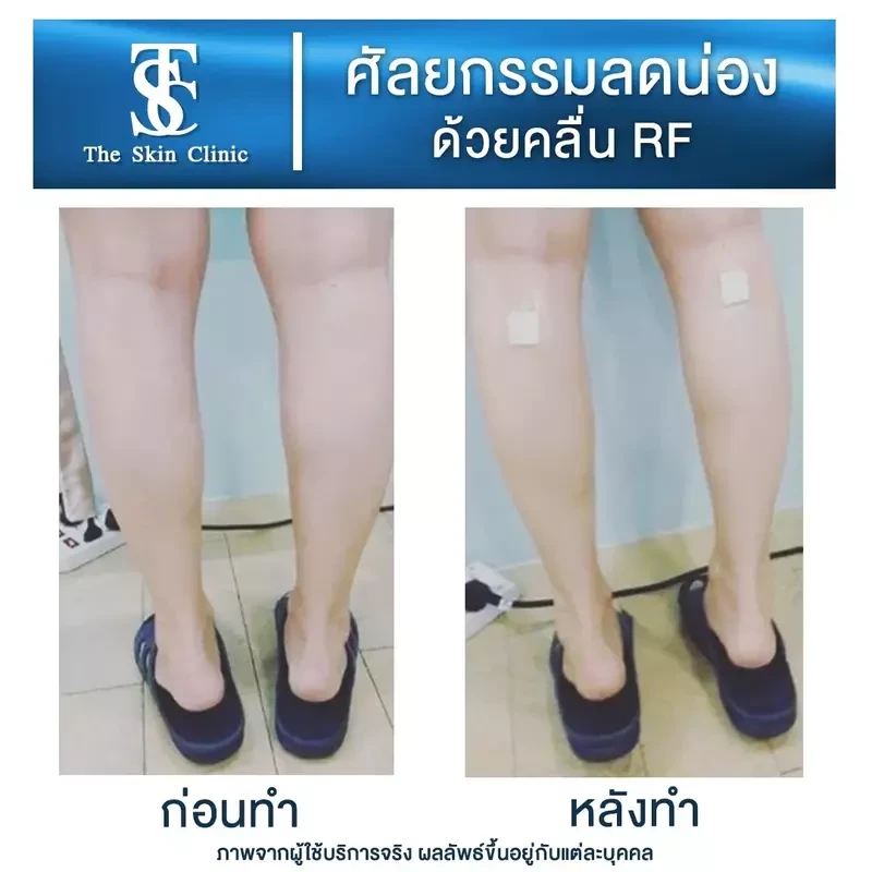 รีวิว ลดน่องด้วยคลื่น RF ที่ The Skin Clinic