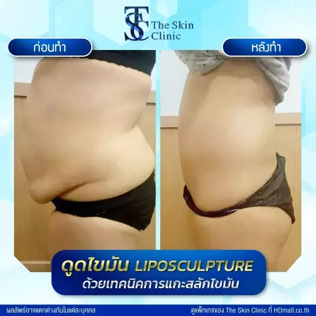 รีวิว ดูดไขมัน ที่ The Skin Clinic