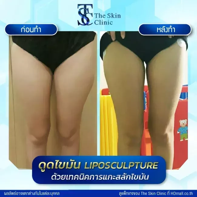 รีวิว ดูดไขมัน ที่ The Skin Clinic