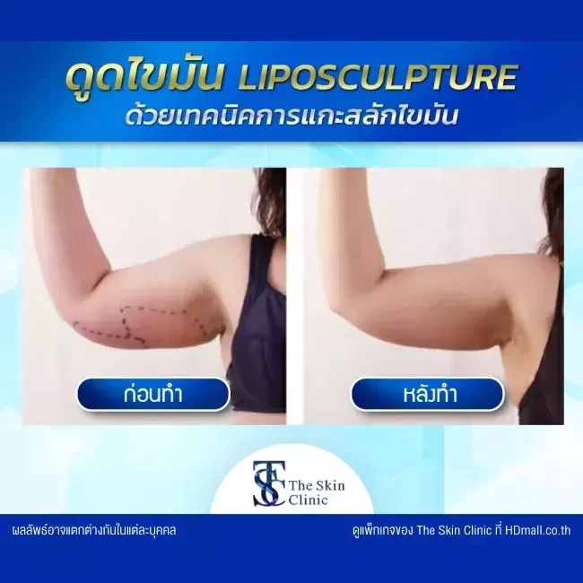 รีวิว ดูดไขมัน ที่ The Skin Clinic