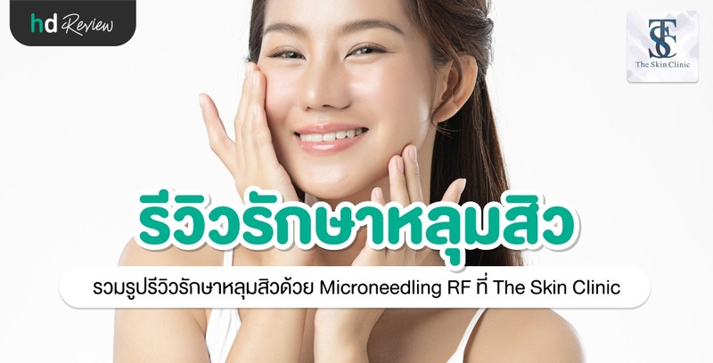 รีวิว รักษาหลุมสิวด้วย Microneedling RF ที่ The Skin Clinic