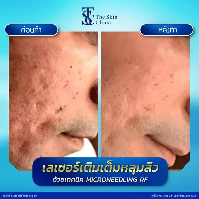 รีวิว รักษาหลุมสิวด้วย Microneedling RF ที่ The Skin Clinic